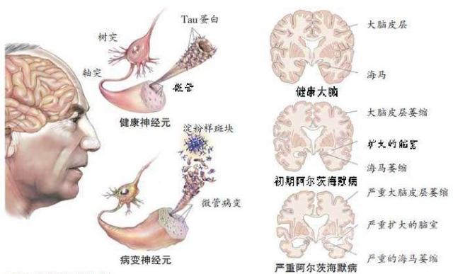 老年痴呆症有救了？首款阿尔茨海默病新药明年初申请上市