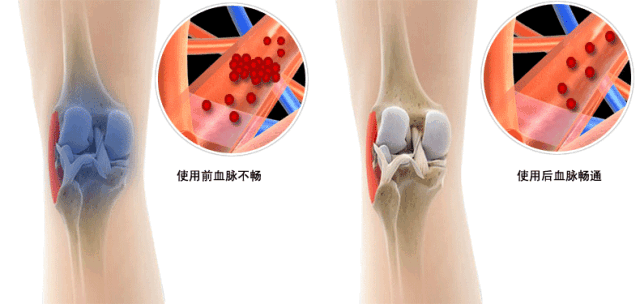 运动后膝盖痛，这么缓解很有效